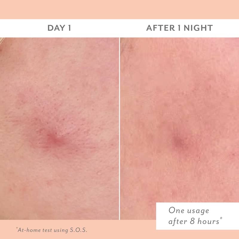sos after overnight use close up pimple