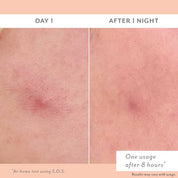 Before and after comparison of SOS skin treatment on Day 1 and After 1 Night.