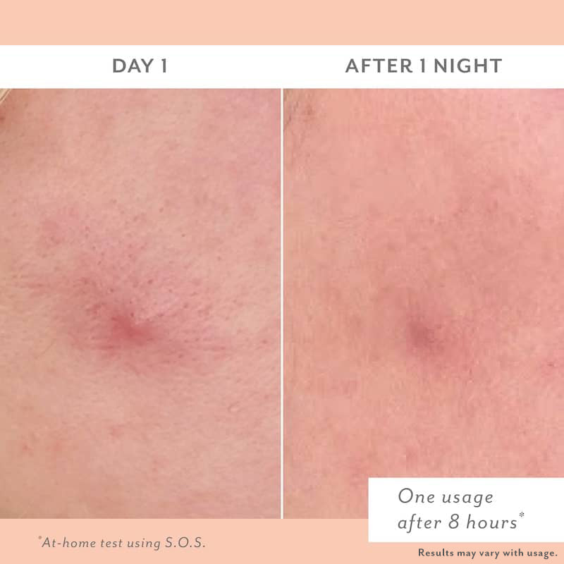Before and after comparison of SOS skin treatment on Day 1 and After 1 Night.