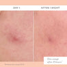 sos after overnight use close up pimple