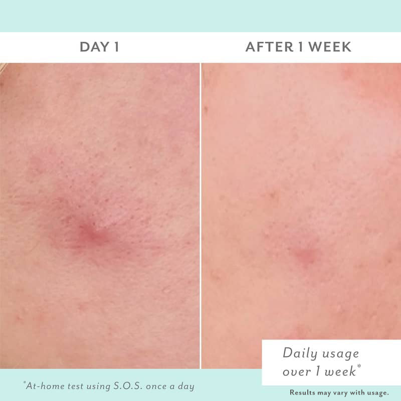 Before and after comparison of skin treatment on Day 1 and After 1 Week.