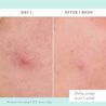 Before and after comparison of skin treatment on Day 1 and After 1 Week with a light blue background.