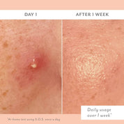 Before and after comparison of skin treatment of SOS on Day 1 and After 1 Week.
