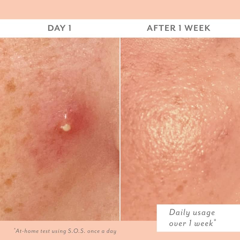 Before and after comparison of skin treatment of SOS on Day 1 and After 1 Week.