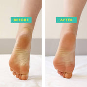 before and after poshpeel pedicure exfoliating chemical peel