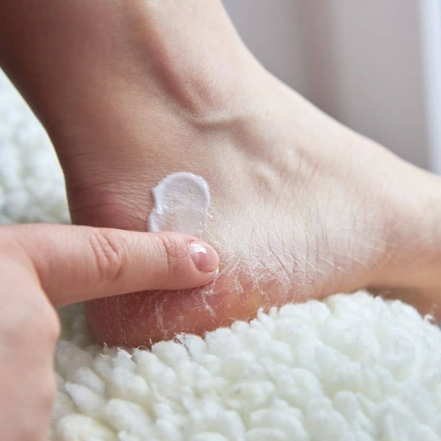 White foot cream being applied to a dry, cracked heel to hydrate and repair skin for a smooth texture.